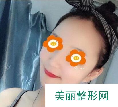 祛斑果对比