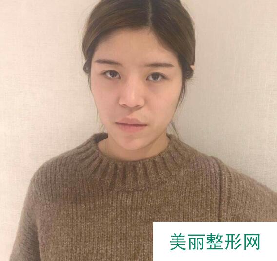 面部填充果
