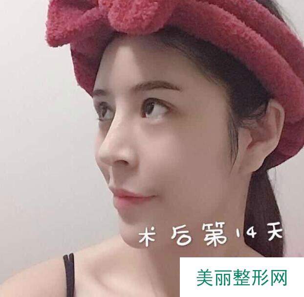 面部填充果
