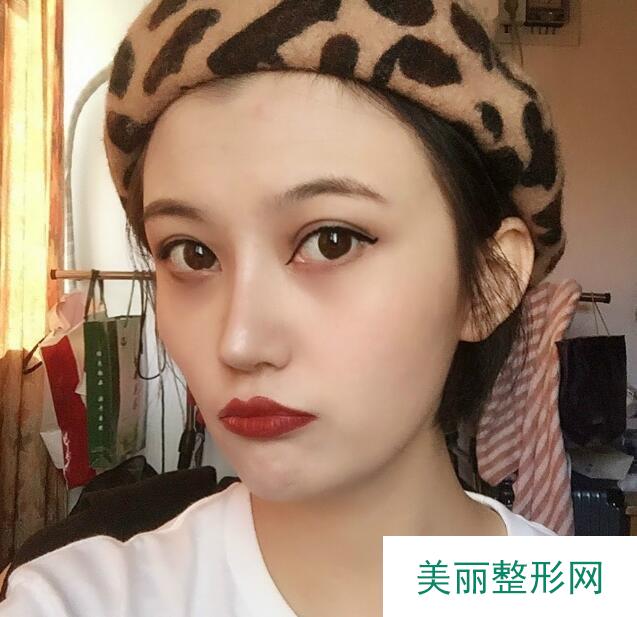 襄阳中心医院整形美容科隆鼻案例