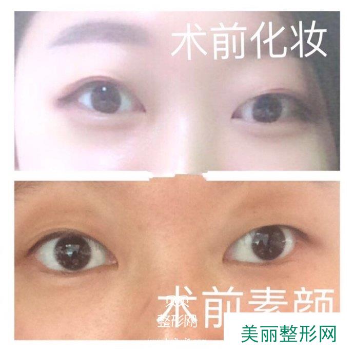 安徽医科大学第一附属医院李小静医生做的全切双眼皮价格是4000+
