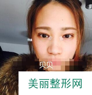 成都素美医院做全切双眼皮+开眼角案例