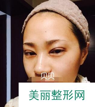 成都素美医院做全切双眼皮+开眼角案例
