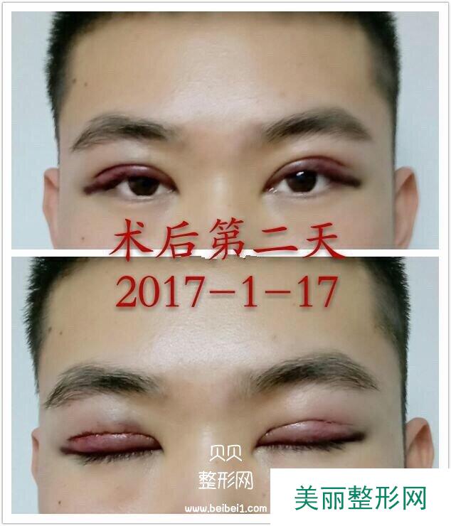 锦州锦美王汇东医生做的微创双眼皮