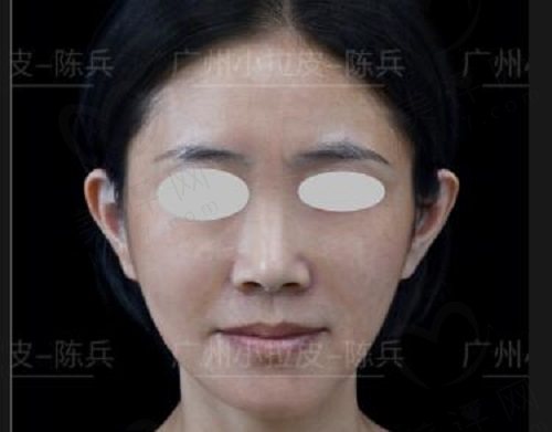 陈兵小切口拉皮真实的病例术后 陈兵小切口拉皮真实的病例术后