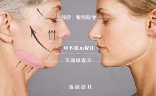 微拉美4.0有哪些优势