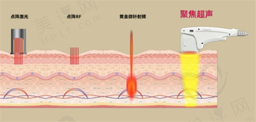 半岛超声炮一次价格多少? 半岛超声炮一次价格多少?