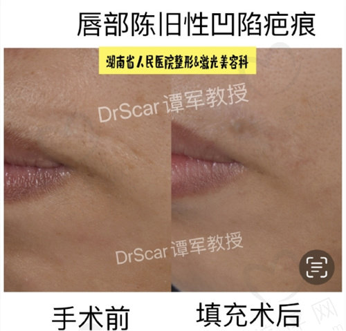 谭军凹陷疤痕的图片