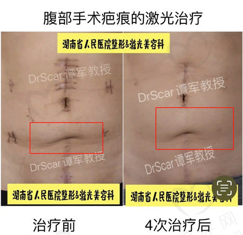 谭军线性疤痕的图片