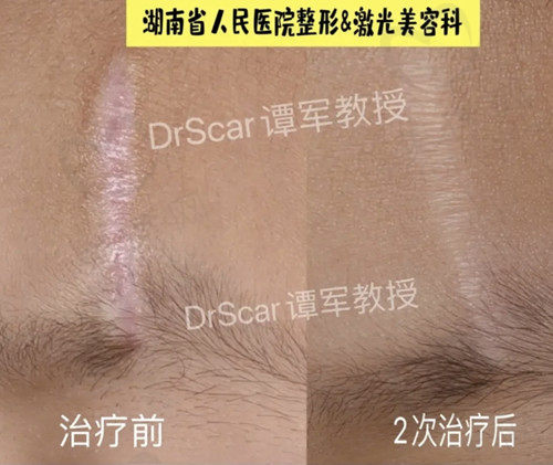 谭军修复疤痕的图片