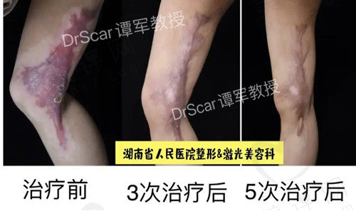 谭军疤痕的图片