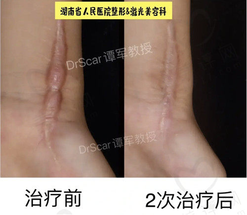 谭军疤痕疙瘩的图片
