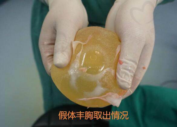 刘成胜做自体脂肪隆胸多少钱？