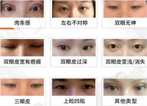 白永辉双眼皮修复怎么样 白永辉双眼皮修复怎么样