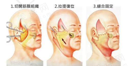 北京加减美面部提升手术优势 北京加减美面部提升手术优势