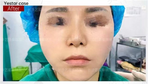 长沙艺星秦晓东拉皮做的好吗 长沙艺星秦晓东拉皮做的好吗
