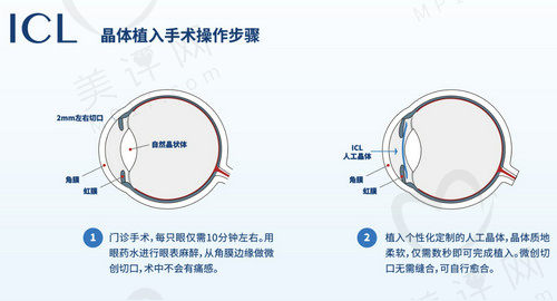 ICL晶体植入术原理 ICL晶体植入术原理