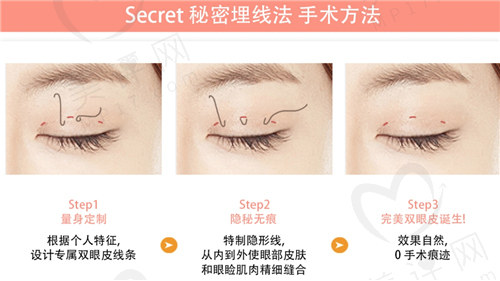 秘密埋线法手术方法 秘密埋线法手术方法