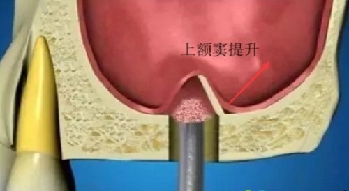 上颌窦提升和种植牙能一起进行吗 上颌窦提升和种植牙能一起进行吗
