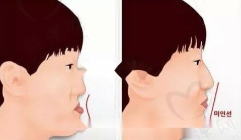 韩国双鄂手术哪家医院好? 韩国双鄂手术哪家医院好?