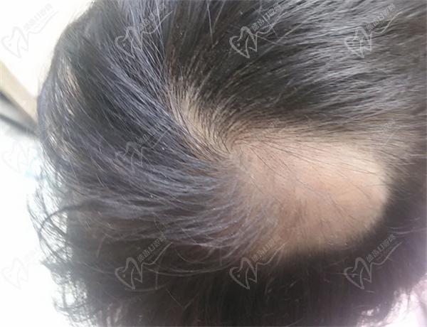 毛囊再生的药物有哪些? 毛囊再生的药物有哪些?