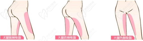 吸脂 吸脂