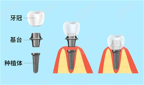 温岭种植牙一颗多少钱？温岭种植牙集采后能便宜多少