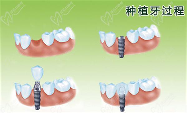 牙齿种植全过程