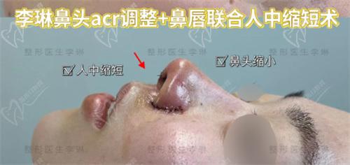 鼻修复医生李琳术例 鼻修复医生李琳术例
