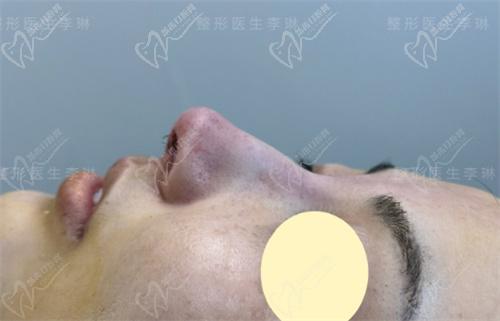李琳医生做鼻子好不好 李琳医生做鼻子好不好