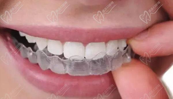 牙齿矫正后需要带保持器吗？