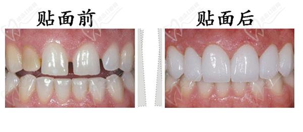 贴面前后对比