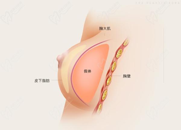 南京做胸部整形医院医生排名榜 南京做胸部整形医院医生排名榜
