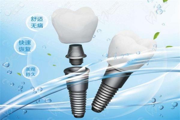 广东省越秀区口腔医院排名种植牙 广东省越秀区口腔医院排名种植牙