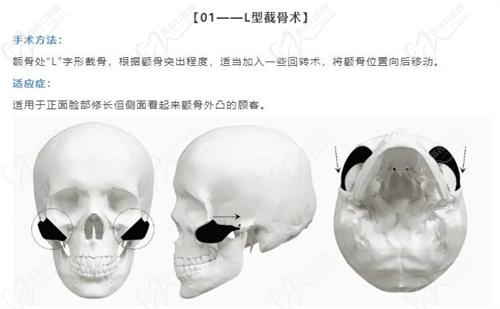 韩国伊美芝做轮廓怎么样