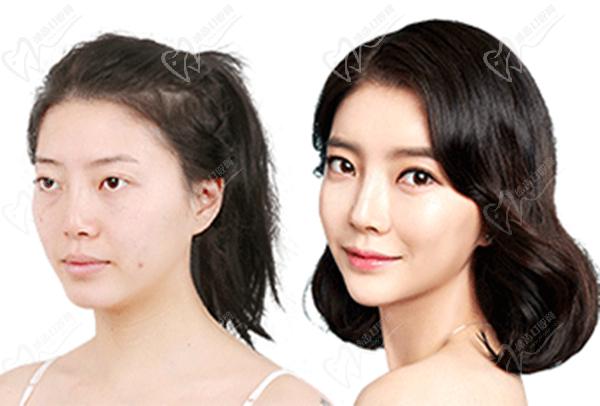 韩国id鼻整形前后对比图 韩国id鼻整形前后对比图
