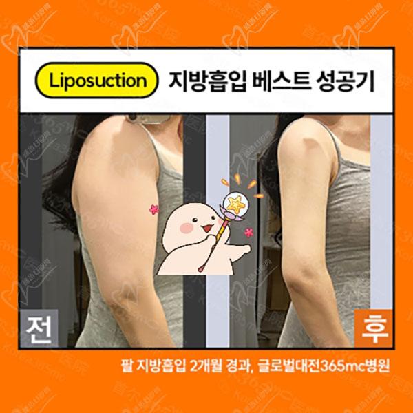 韩国365mc吸脂手臂吸脂术后图 韩国365mc吸脂手臂吸脂术后图