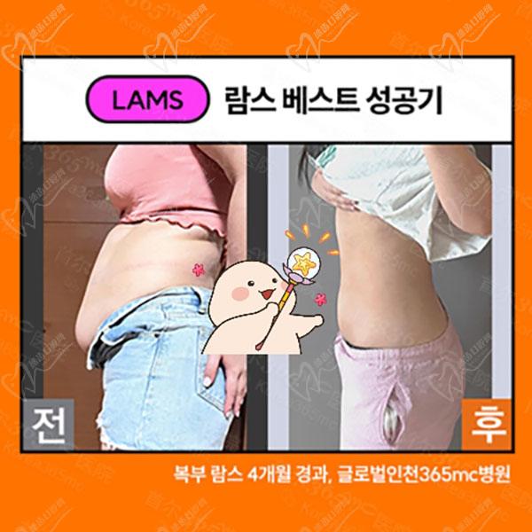 韩国365mc吸脂腹部抽脂术后图 韩国365mc吸脂腹部抽脂术后图