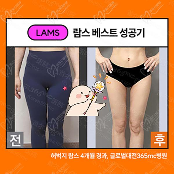 韩国365mc吸脂大腿吸脂术后图 韩国365mc吸脂大腿吸脂术后图