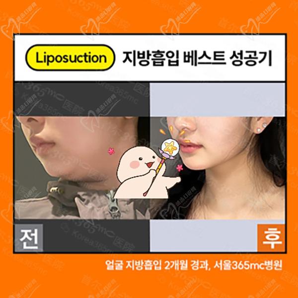 韩国365mc吸脂面部吸脂术后图 韩国365mc吸脂面部吸脂术后图