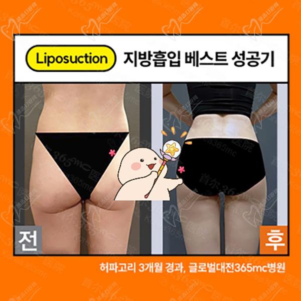 韩国365mc吸脂细腰蜂臀术后图 韩国365mc吸脂细腰蜂臀术后图