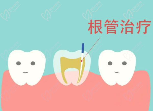 根管 根管