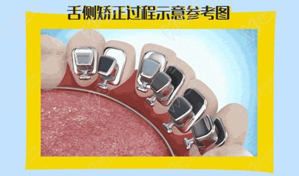 舌侧隐形矫正需要多长时间