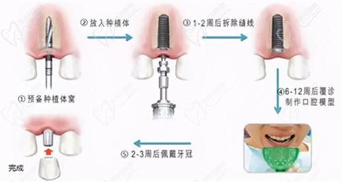 上海清木口腔医院种植牙怎么样? 上海清木口腔医院种植牙怎么样?