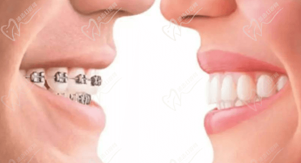 牙齿矫正 牙齿矫正