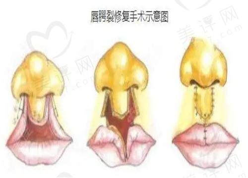 重庆美仑美奂整形医院做唇腭裂好吗 重庆美仑美奂整形医院做唇腭裂好吗