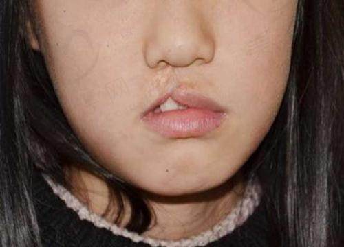 重庆美仑美奂整形医院做唇腭裂好吗 重庆美仑美奂整形医院做唇腭裂好吗