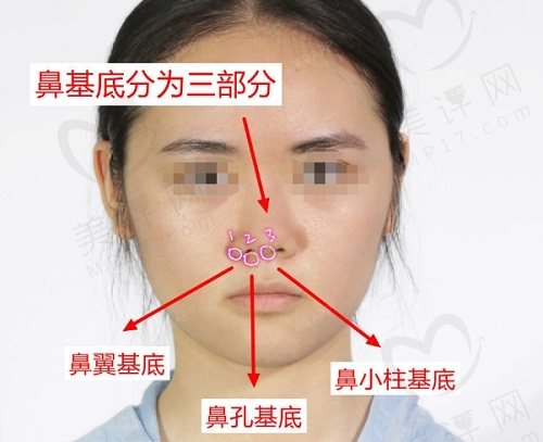 鼻基底填充用什么材料比较好 鼻基底填充用什么材料比较好