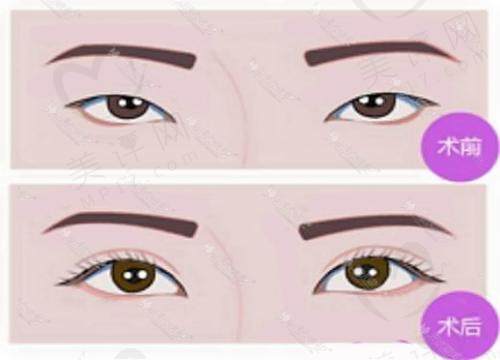 重庆李富强双眼皮<span style= 重庆李富强双眼皮<span style=