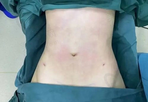 腹部成型手术什么情况需要做 腹部成型手术什么情况需要做